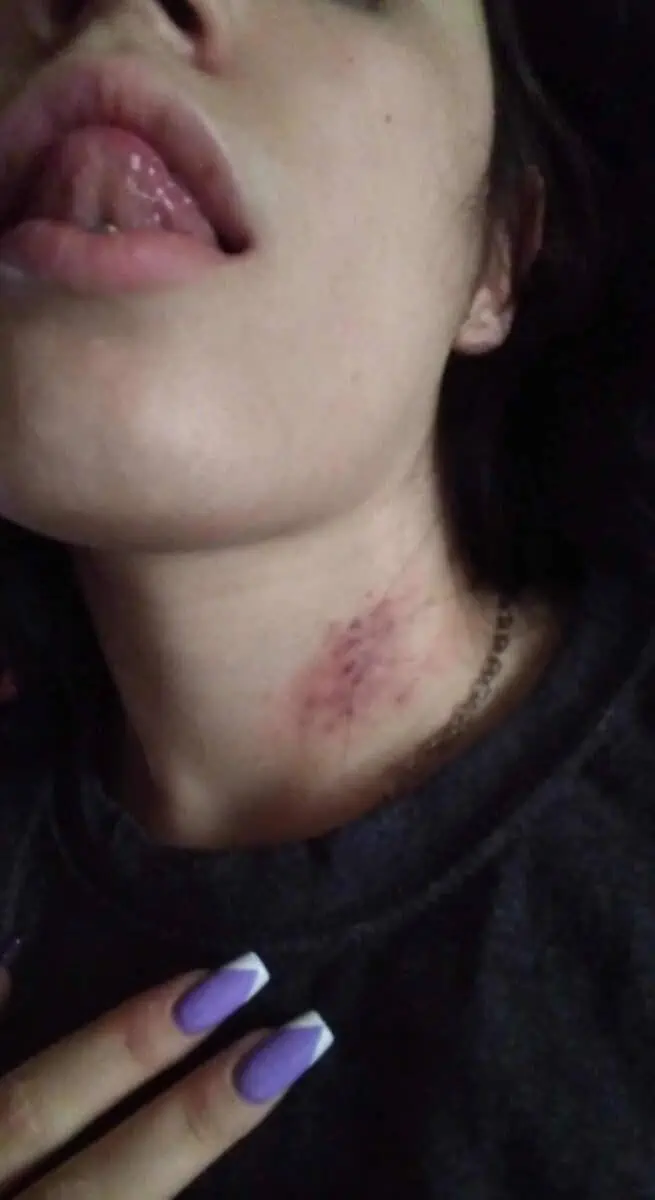 Hickey in a woman's neck